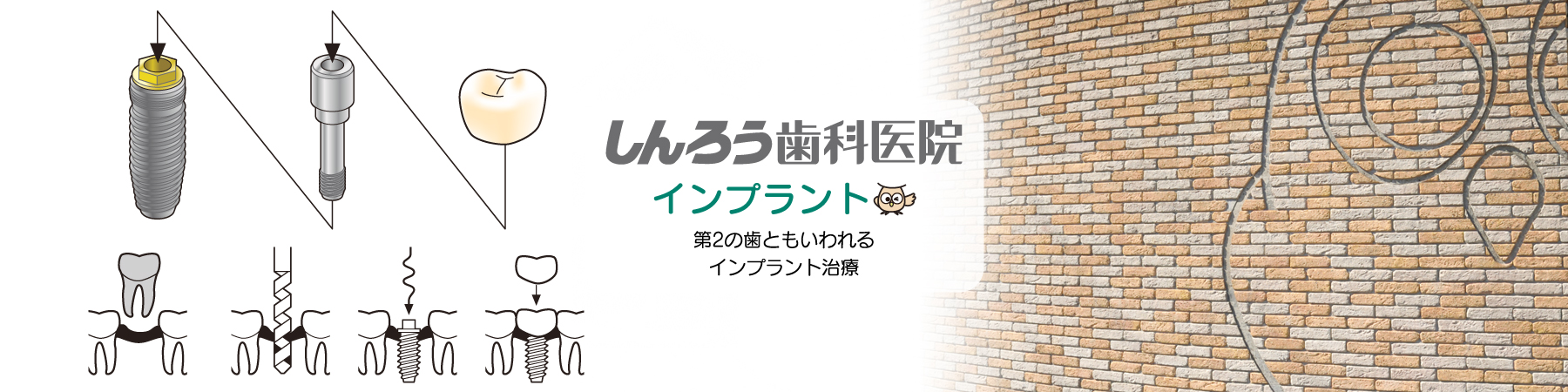 しんろう歯科医院・インプラント治療