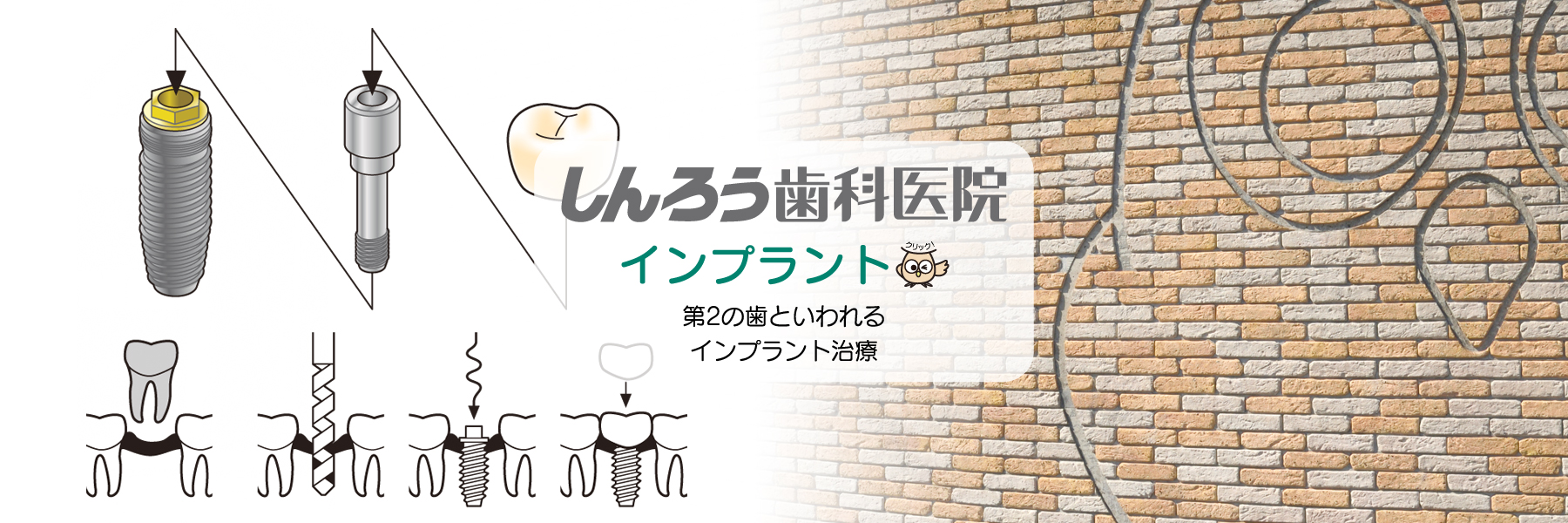 大分県大分市片島・しんろう歯科医院・インプラント