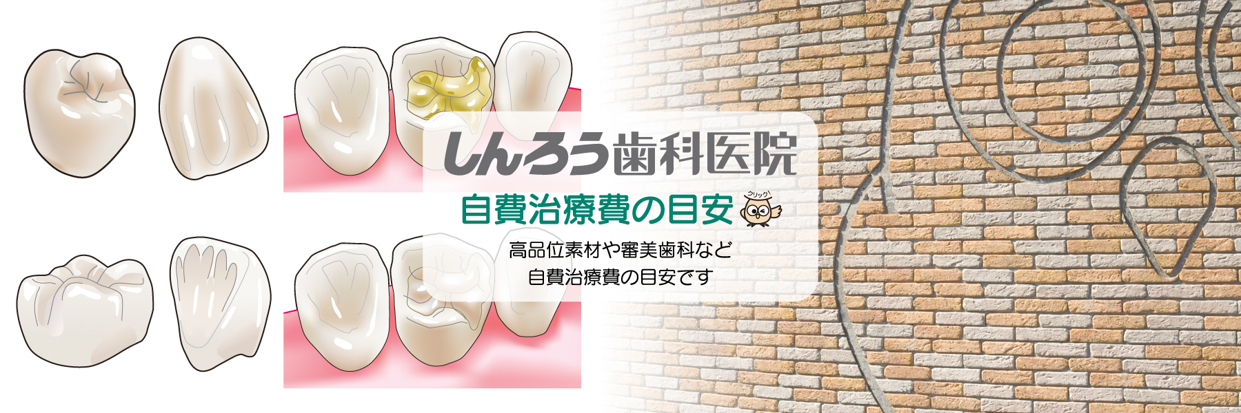 大分県大分市片島・しんろう歯科医院・自費治療費の目安